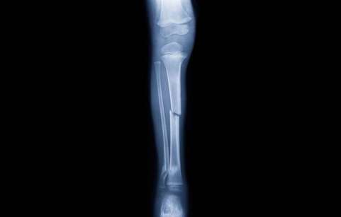 شکستگی استخوان چیست و انواع آن کدام اند؟