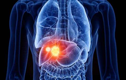 سرطان کبد چیست؟ علائم، علت، تشخیص و درمان
